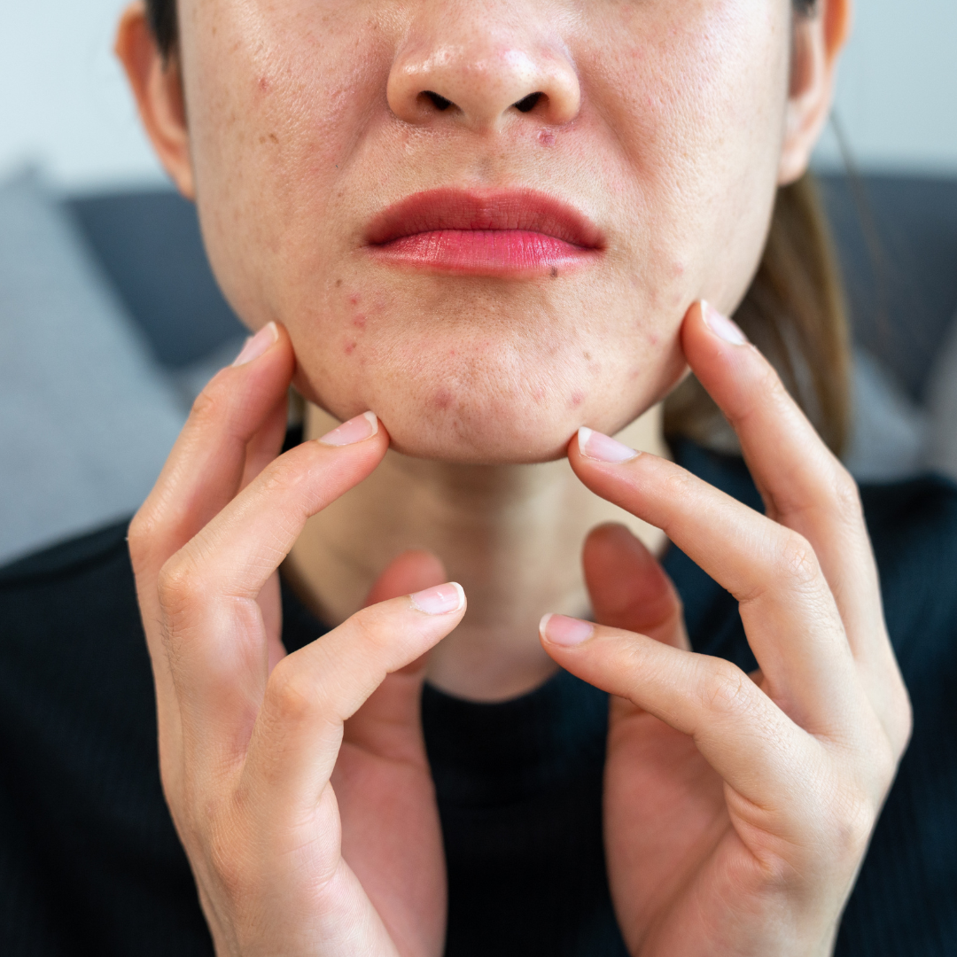 Rutina de Skincare para Controlar Imperfecciones y Piel Grasa (Día)