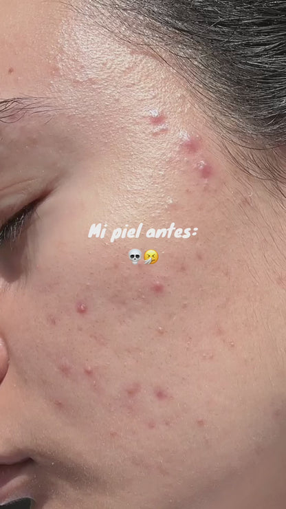 Peeling Solution | Sérum exfoliante